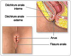 fissure anale