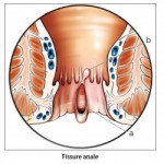 fissure anale